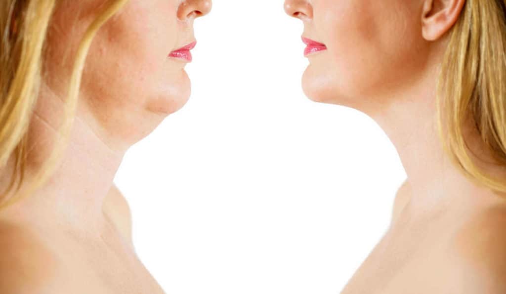Double Chin treatment Acocks Green before and after results