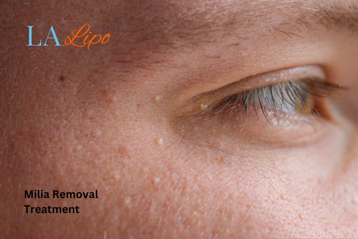 Cryopen Milia Removal: Is It the Easiest and Safest Option Acocks Green?