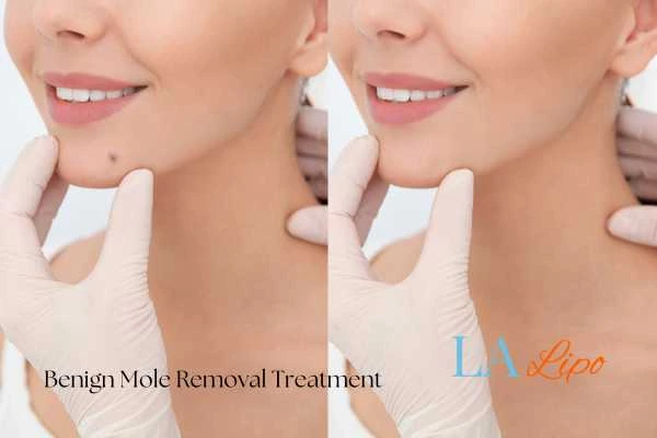 woman's before and after mole removal Acocks Green results