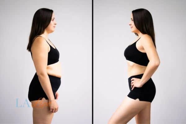 image of woman before and after results of LA-EMS Body Sculpting Acocks Green to help treat Diastasis recti