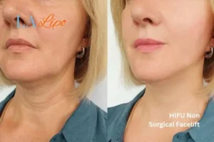 hi-fu for wrinkles Acocks Green before and after results