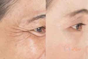 Before and after results of woman - HI-fu wrinkles reduction treatment Acocks Green