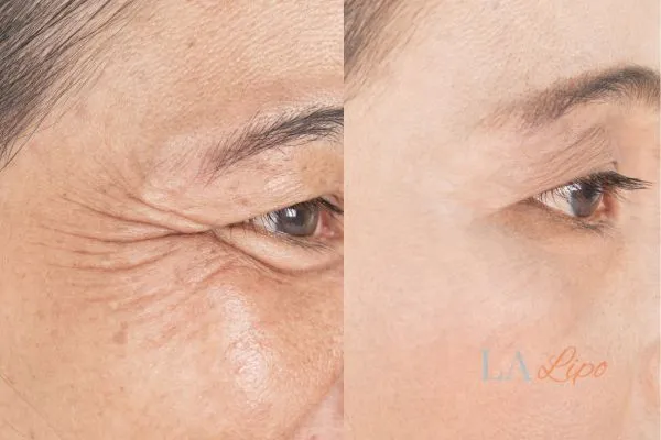 Before and after results of woman - HI-fu wrinkles reduction treatment Acocks Green