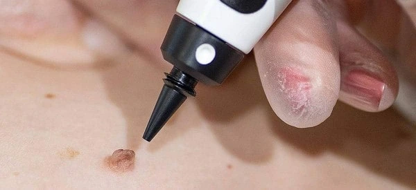 skin tag removal using cryopen Acocks Green