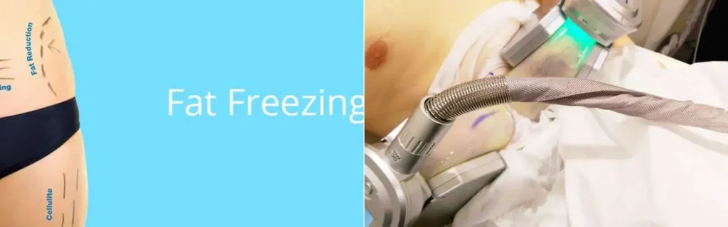 Fat freezing Acocks Green on multiple areas of the body