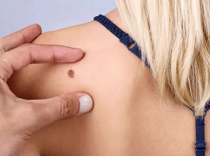 woman having mole removal Acocks Green consultation before treatment.