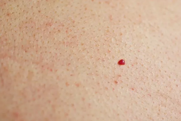 close up of a cherry angioma Acocks Green