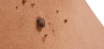 image of a skin tag Acocks Green