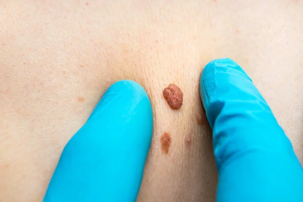 Consultant examining a skin tag Acocks Green