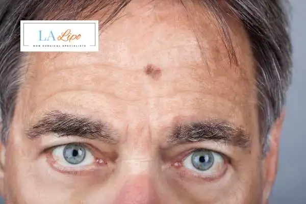 Solar Lentigo Removal Acocks Green image of man with mark on his forehead