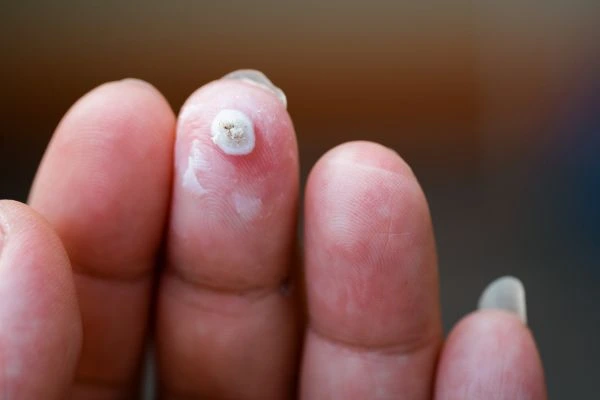 wart on person finger - cryotherapy to treat from LA LIPO Acocks Green