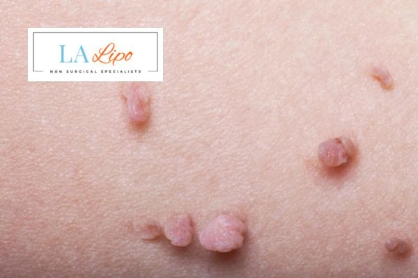 Does cryopen skin tag removal Acocks Green hurt? Find out now call our team today!