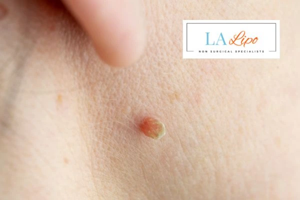 Book skin tag removal Acocks Green today speak to our team now!