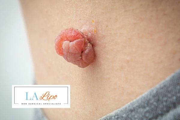 Interested in skin tag removal Acocks Green? Concerned about the pain? Find out more today!