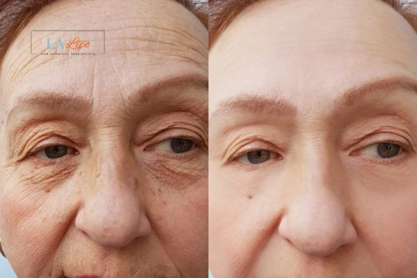 The powerful benefits of Morpheus8 Treatment Acocks Green - Call Our team today!