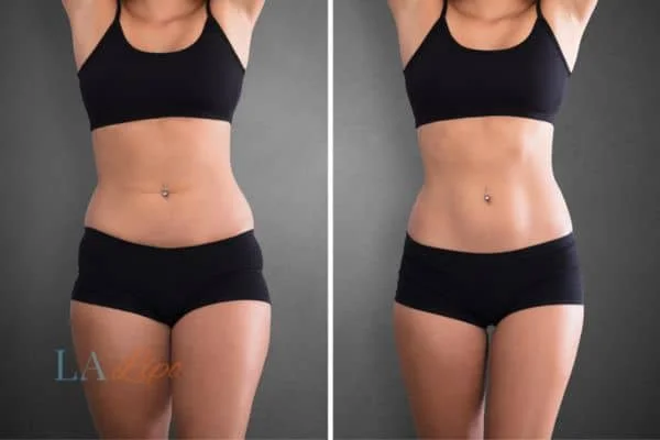 before and after results of non-surgical treatment to help a woman's body image and mental health Acocks Green