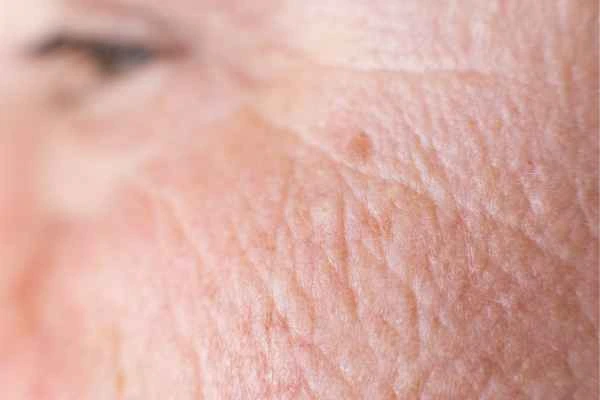 close up picture of a woman's face showing an age spot Acocks Green