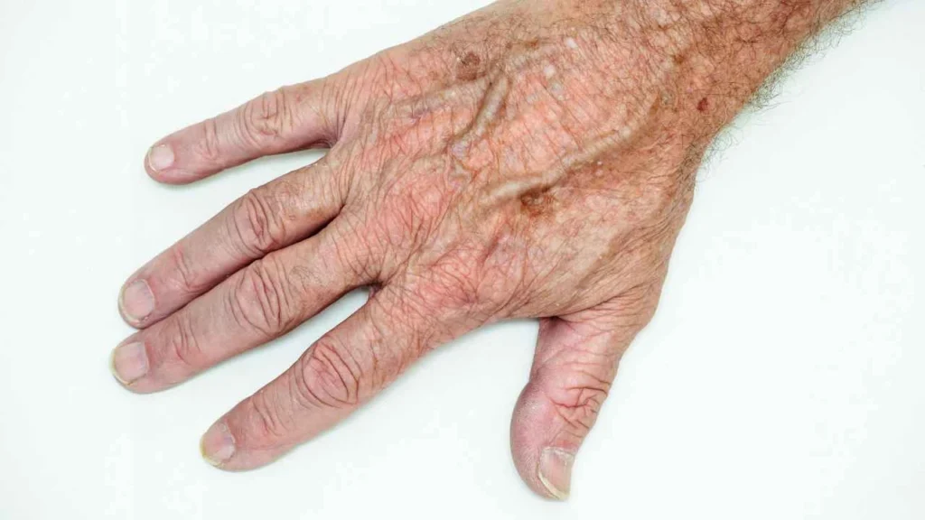 Male hand showing age spot Acocks Green