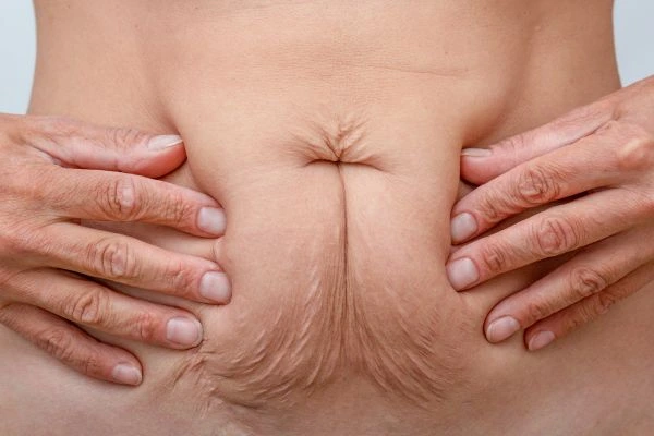 Image of a woman's stomach with loose skin - example of skin tightening Acocks Green options