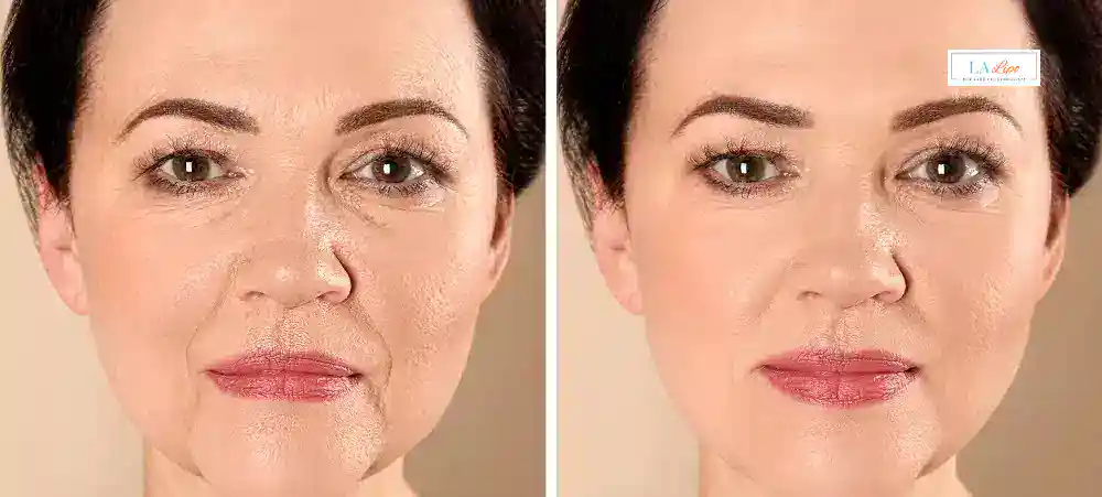How Long Does It Take to See Results and How Long Do They Last Acocks Green?